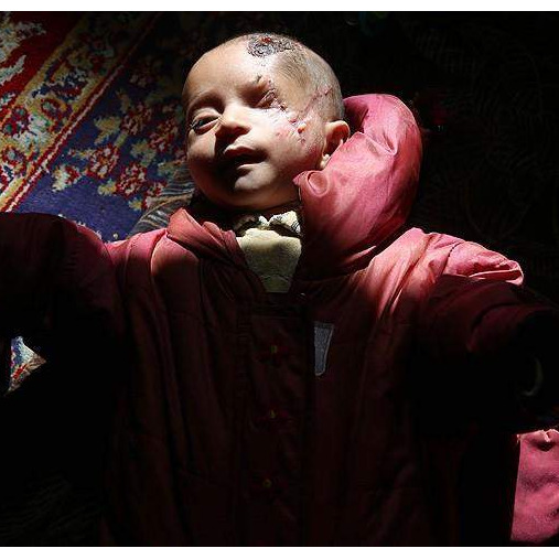 Sirija: Dvomjesečni Karim bori se za život nakon što je teško ranjen