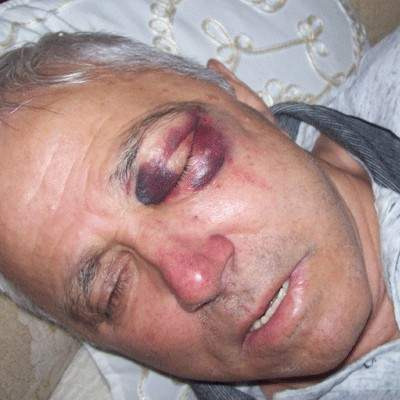 Zvornik: Umro Nezir Dardagan koji je pretučen na Bajram prije četiri godine