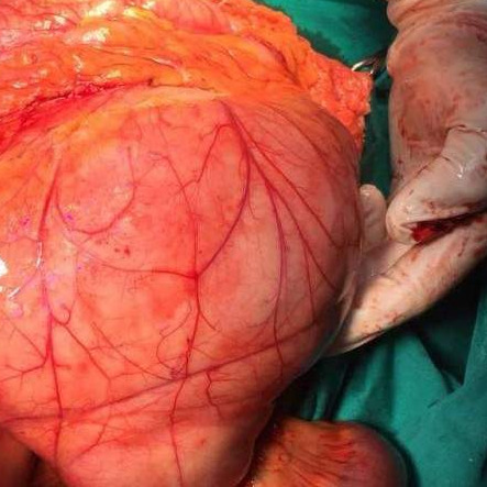 Na KCUS-u pacijentici odstranjen tumor od 11,4 kilograma 