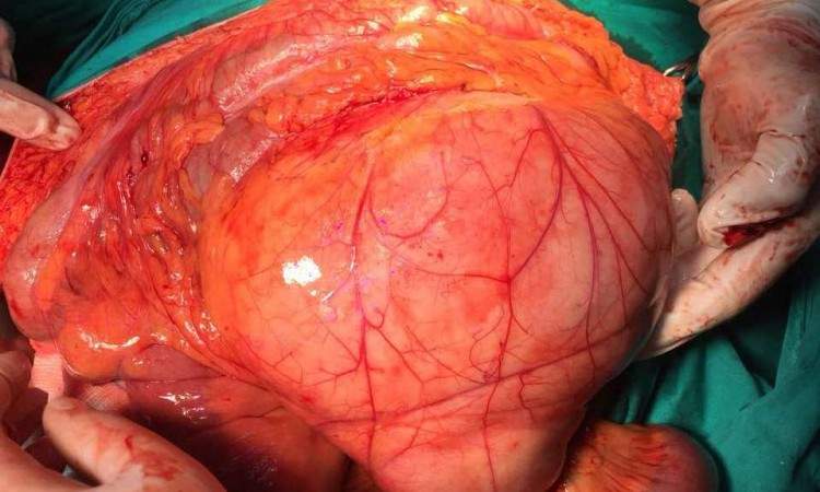 Na KCUS-u pacijentici odstranjen tumor od 11,4 kilograma
